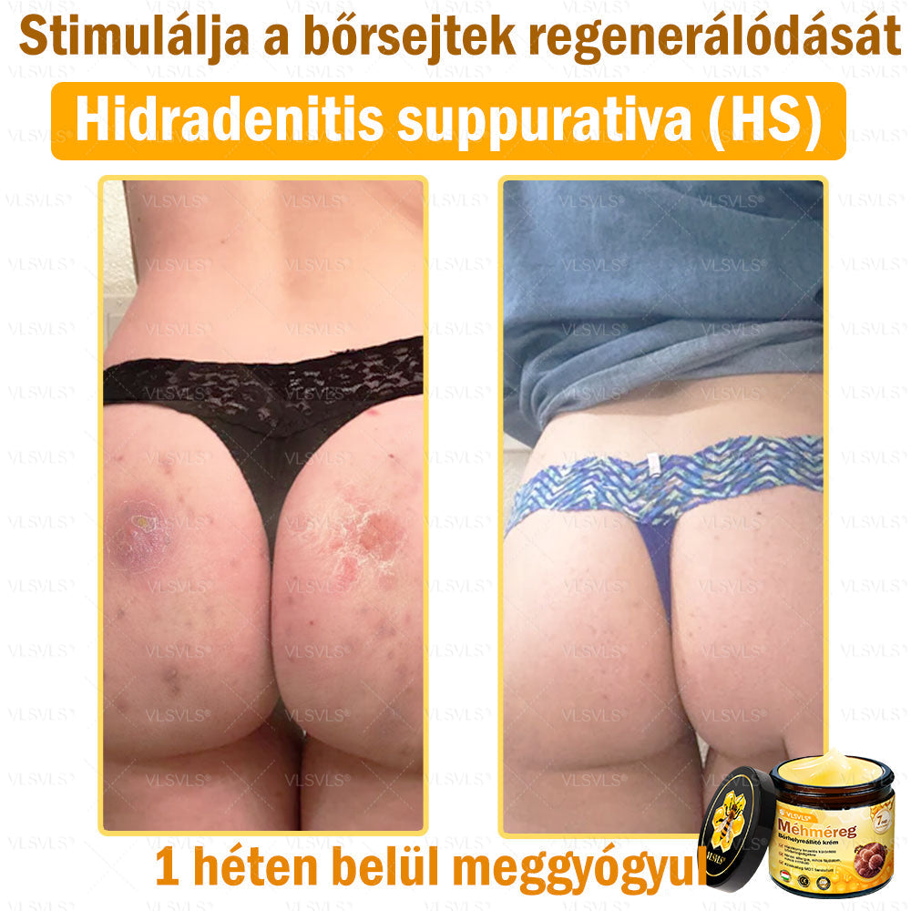 🎀🎀VLSVLS® 𝐌É𝐇𝐌É𝐑𝐄𝐆 Á𝐓𝐅𝐎𝐆Ó 𝐊𝐑É𝐌🥇𝐀 𝐛ö𝐫𝐩𝐫𝐨𝐛𝐥é𝐦á𝐤 𝐤𝐞𝐳𝐞𝐥é𝐬𝐞 𝐦𝐚𝐠á𝐛𝐚𝐧 𝐟𝐨𝐠𝐥𝐚𝐥𝐣𝐚: é𝐥𝐞𝐭𝐤𝐨𝐫𝐢 𝐟𝐨𝐥𝐭𝐨𝐤, 𝐡𝐞𝐠𝐞𝐤, 𝐬𝐳𝐞𝐦ö𝐥𝐜𝐬ö𝐤, 𝐛ö𝐫𝐧ö𝐯𝐞𝐝é𝐤𝐞𝐤, 𝐭á𝐥𝐲𝐨𝐠𝐨𝐤, 𝐩𝐚𝐭𝐭𝐚𝐧á𝐬𝐨𝐤, 𝐞𝐤𝐜é𝐦𝐚, 𝐩𝐬𝐨𝐫𝐢𝐚𝐬𝐢𝐬, 𝐚𝐜𝐧𝐞 𝐢𝐧𝐯𝐞𝐫𝐬𝐚, 𝐫á𝐧𝐜𝐨𝐤, 𝐛ö𝐫ö𝐫𝐞𝐠𝐞𝐝é𝐬 é𝐬 𝐞𝐠𝐲é𝐛 𝐩𝐫𝐨𝐛𝐥é𝐦á𝐤🔥