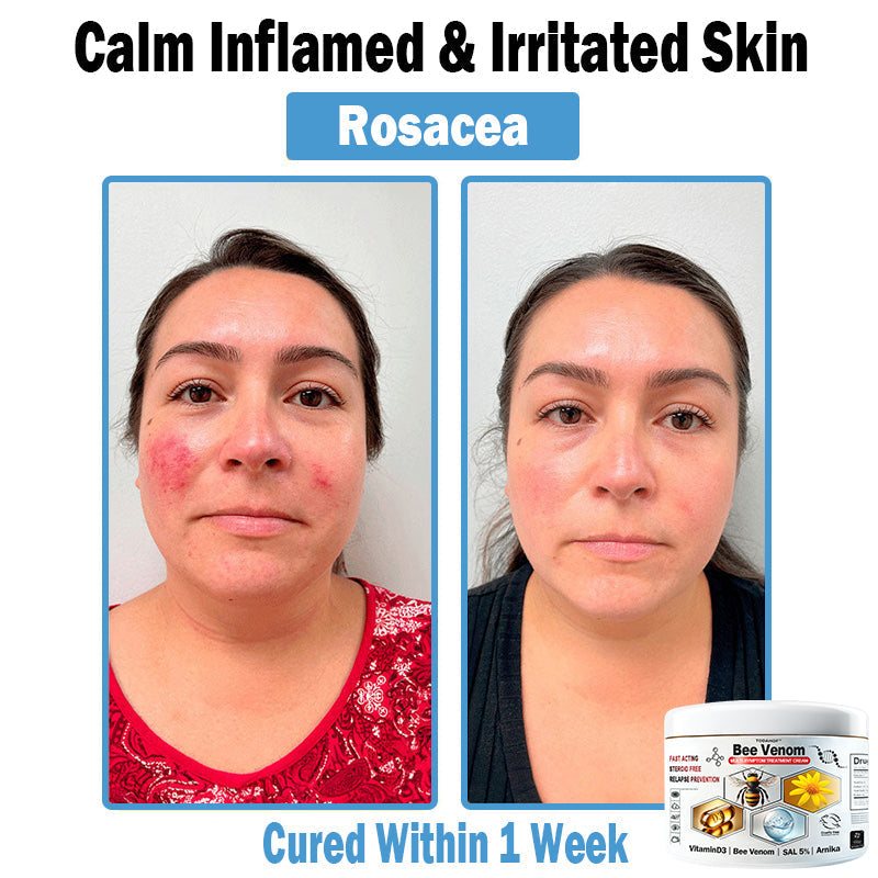 TO𝐃𝐀HOF®🥥🍈 𝑩𝒆𝐞 𝑽𝐞𝒏𝒐𝒎 𝑴𝒖𝒍𝒕𝒊-𝑺𝒚𝒎𝒑𝒕𝒐𝒎 𝑺𝒌𝒊𝒏 𝑻𝒓𝒆𝒂𝒕𝒎𝐞𝒏𝒕 𝑪𝒓𝐞𝒂𝒎