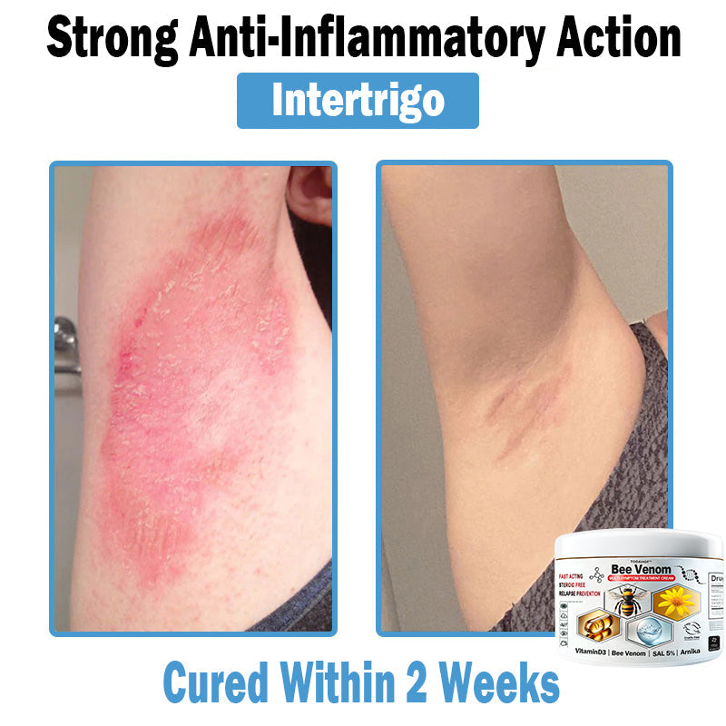 TO𝐃𝐀HOF®🥥🍈 𝑩𝒆𝐞 𝑽𝐞𝒏𝒐𝒎 𝑴𝒖𝒍𝒕𝒊-𝑺𝒚𝒎𝒑𝒕𝒐𝒎 𝑺𝒌𝒊𝒏 𝑻𝒓𝒆𝒂𝒕𝒎𝐞𝒏𝒕 𝑪𝒓𝐞𝒂𝒎