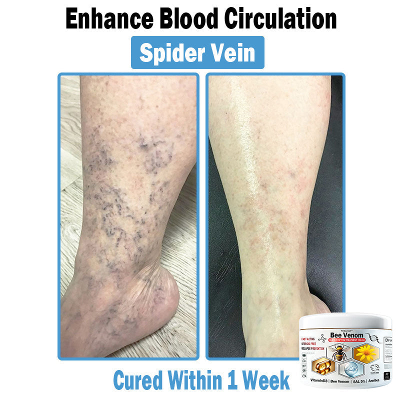 TO𝐃𝐀HOF®🥥🍈 𝑩𝒆𝐞 𝑽𝐞𝒏𝒐𝒎 𝑴𝒖𝒍𝒕𝒊-𝑺𝒚𝒎𝒑𝒕𝒐𝒎 𝑺𝒌𝒊𝒏 𝑻𝒓𝒆𝒂𝒕𝒎𝐞𝒏𝒕 𝑪𝒓𝐞𝒂𝒎