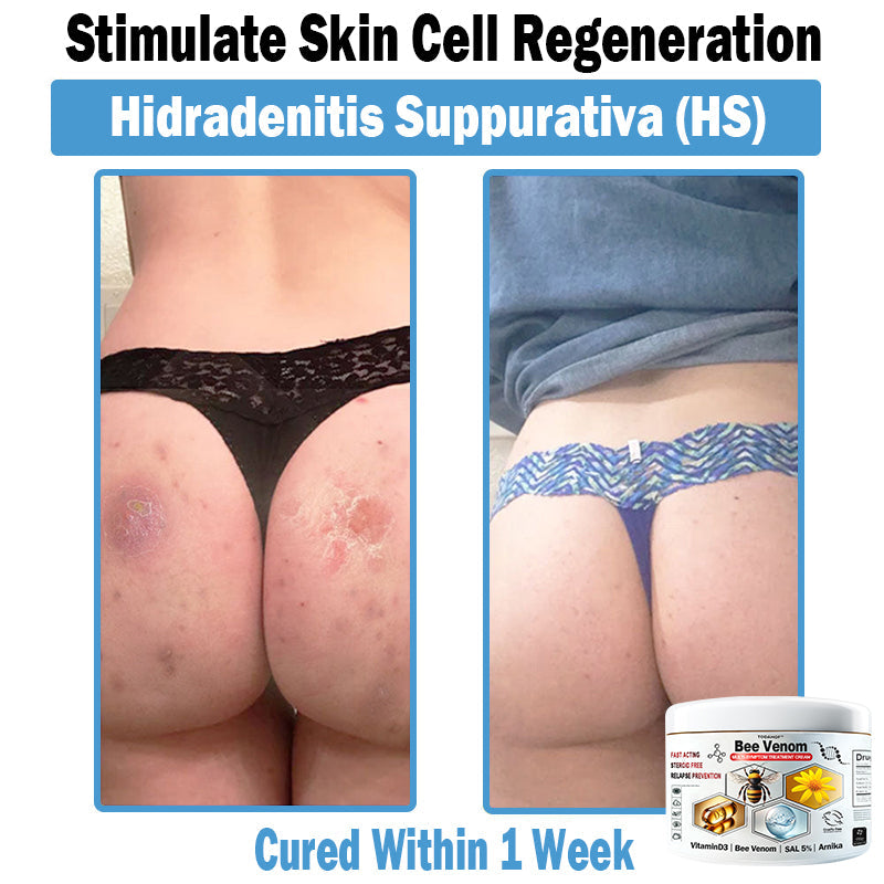 TO𝐃𝐀HOF®🥥🍈 𝑩𝒆𝐞 𝑽𝐞𝒏𝒐𝒎 𝑴𝒖𝒍𝒕𝒊-𝑺𝒚𝒎𝒑𝒕𝒐𝒎 𝑺𝒌𝒊𝒏 𝑻𝒓𝒆𝒂𝒕𝒎𝐞𝒏𝒕 𝑪𝒓𝐞𝒂𝒎