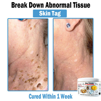 TO𝐃𝐀HOF®🥥🍈 𝑩𝒆𝐞 𝑽𝐞𝒏𝒐𝒎 𝑴𝒖𝒍𝒕𝒊-𝑺𝒚𝒎𝒑𝒕𝒐𝒎 𝑺𝒌𝒊𝒏 𝑻𝒓𝒆𝒂𝒕𝒎𝐞𝒏𝒕 𝑪𝒓𝐞𝒂𝒎