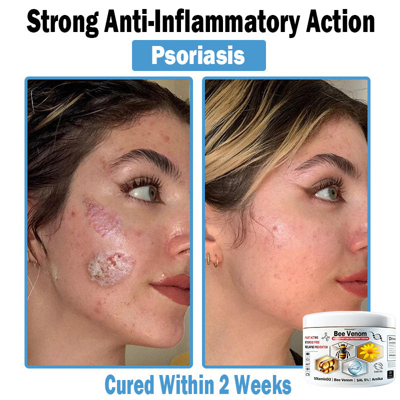 TO𝐃𝐀HOF®🥥🍈 𝑩𝒆𝐞 𝑽𝐞𝒏𝒐𝒎 𝑴𝒖𝒍𝒕𝒊-𝑺𝒚𝒎𝒑𝒕𝒐𝒎 𝑺𝒌𝒊𝒏 𝑻𝒓𝒆𝒂𝒕𝒎𝐞𝒏𝒕 𝑪𝒓𝐞𝒂𝒎