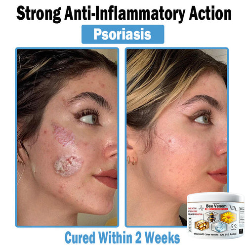 TO𝐃𝐀HOF®🥥🍈 𝑩𝒆𝐞 𝑽𝐞𝒏𝒐𝒎 𝑴𝒖𝒍𝒕𝒊-𝑺𝒚𝒎𝒑𝒕𝒐𝒎 𝑺𝒌𝒊𝒏 𝑻𝒓𝒆𝒂𝒕𝒎𝐞𝒏𝒕 𝑪𝒓𝐞𝒂𝒎